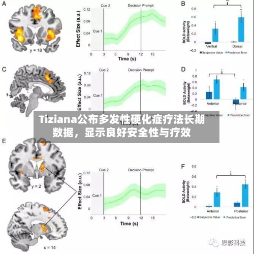 Tiziana公布多发性硬化症疗法长期数据,显示良好安全性与疗效
